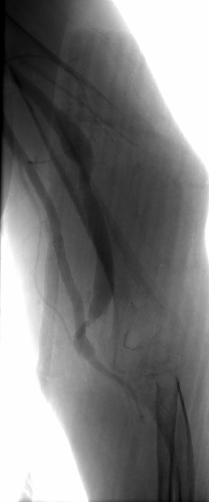 SILENE peripheral angiographic image