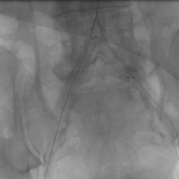 SILENE angiographic view of the delivery system