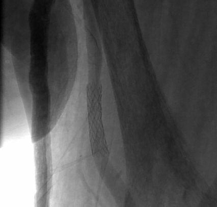 SILENE stent shown in an angiographic image