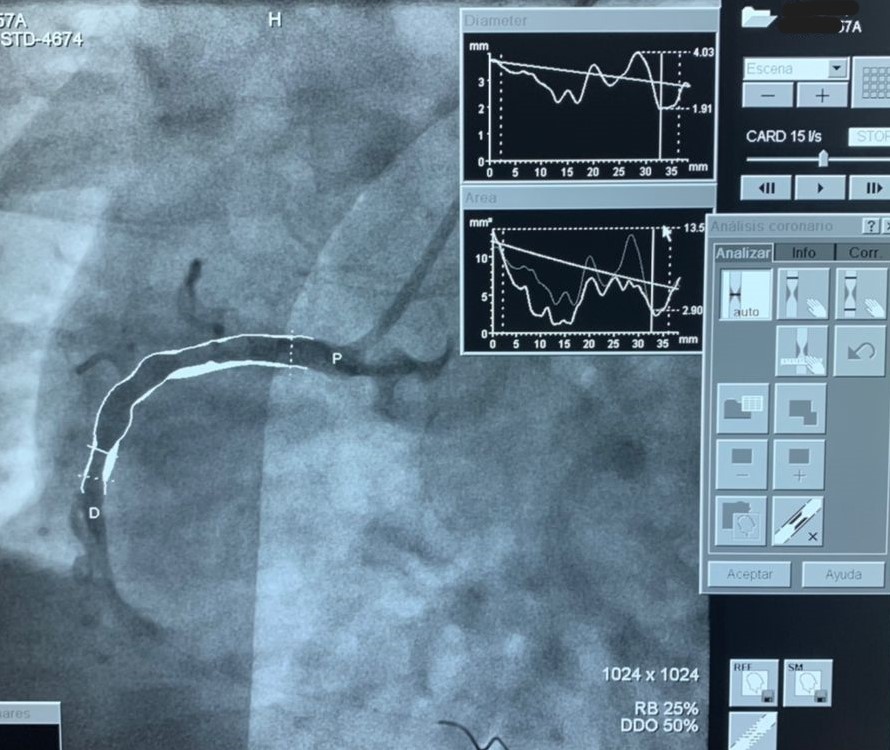 SIRO angiographic image with vessel measurements