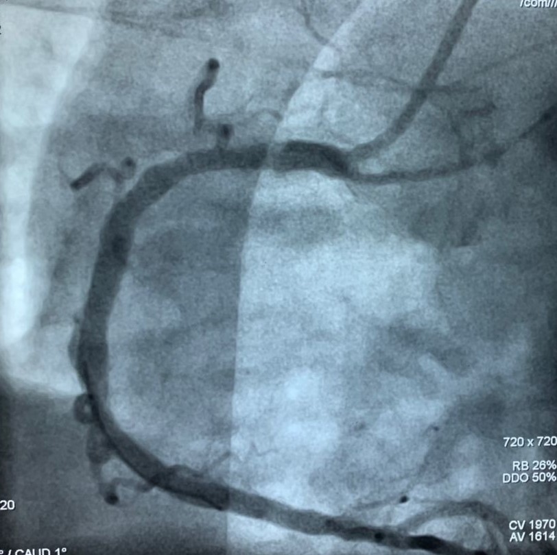 SIRO coronary angiographic image